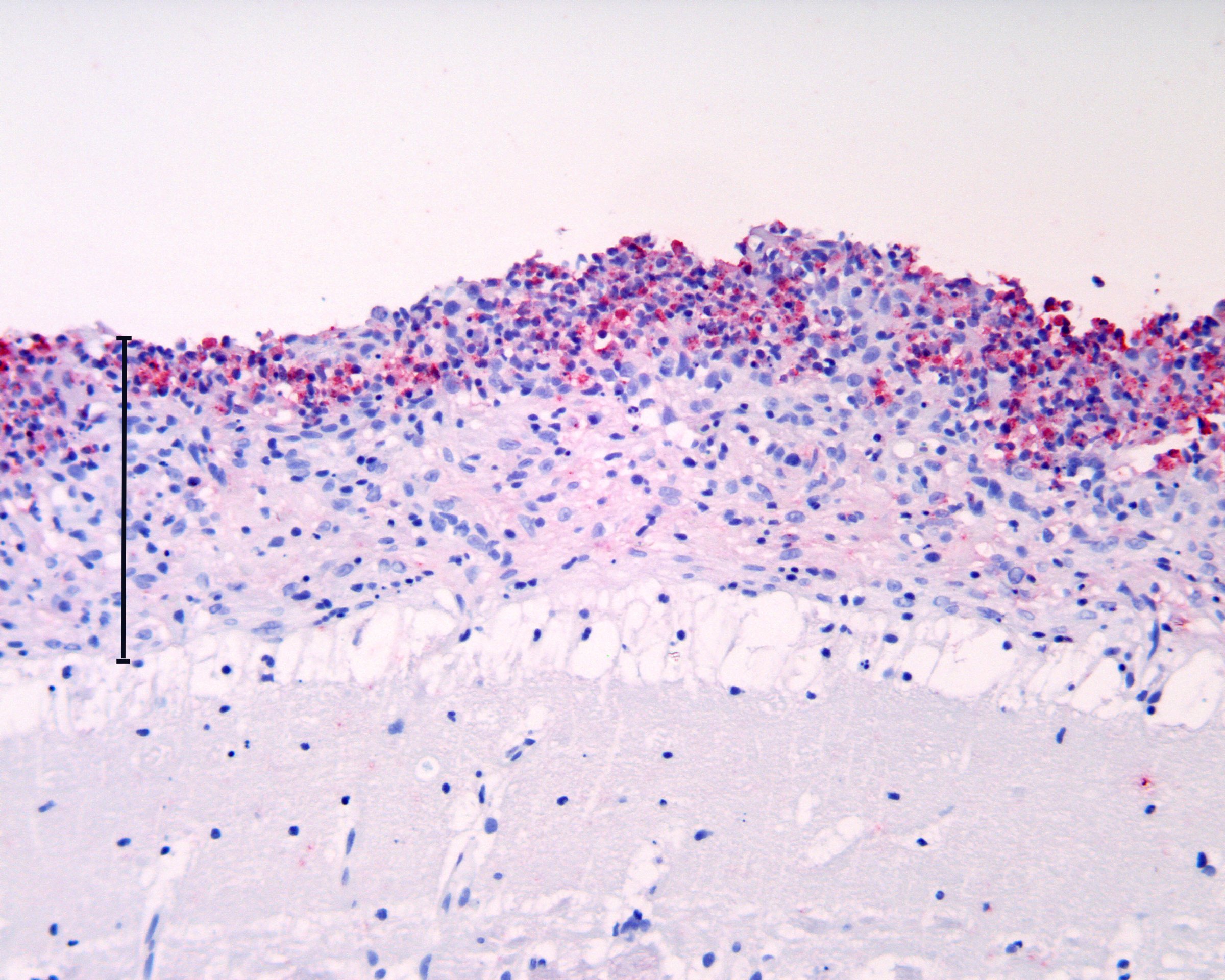 Laks med hjernehinnebetennelse (meningitt) forårsaket av Renibacterium salmoninarum (rosa farging med immunhistokjemi). Foto: Anne Berit Olsen, Veterinærinstituttet.