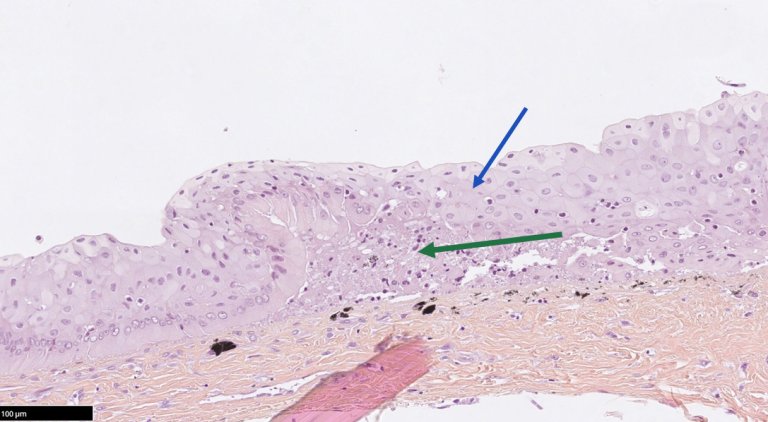 Bildet viser hud hos hunderørret med mistanke om Ulcerativ dermal nekrose (UDN). I epidermis sees oppsvulmede og degenerative epitelceller (blå pil) med subepidermal nekrose (grønn pil). Foto: Toni Erkinharju, Veterinærinstituttet 