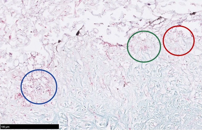 Histopatologisk snitt: Her hudsår hos sjøørret fra Nidelva med saprolegnia, Gram negative kort staver (grønn sirkel), Gram –negative lange staver (rød sirkel) og Gram positive kokker (blå sirkel). Foto: Toni Erkinharju, Veterinærinstituttet 