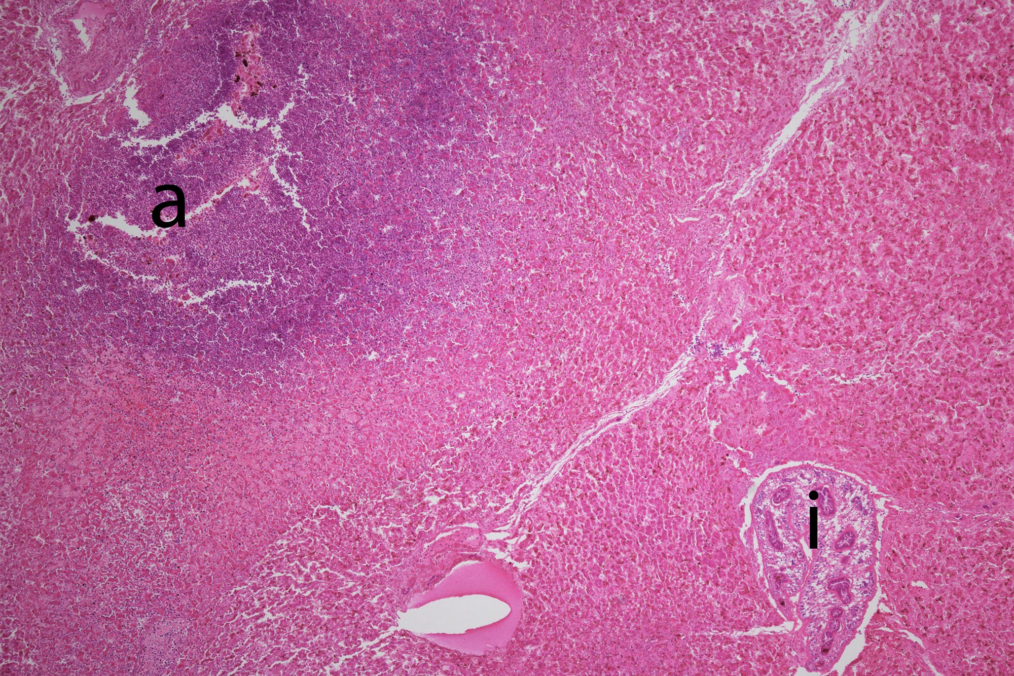 Figur 3. p512-17. Lever med absces og ikte_web.jpg