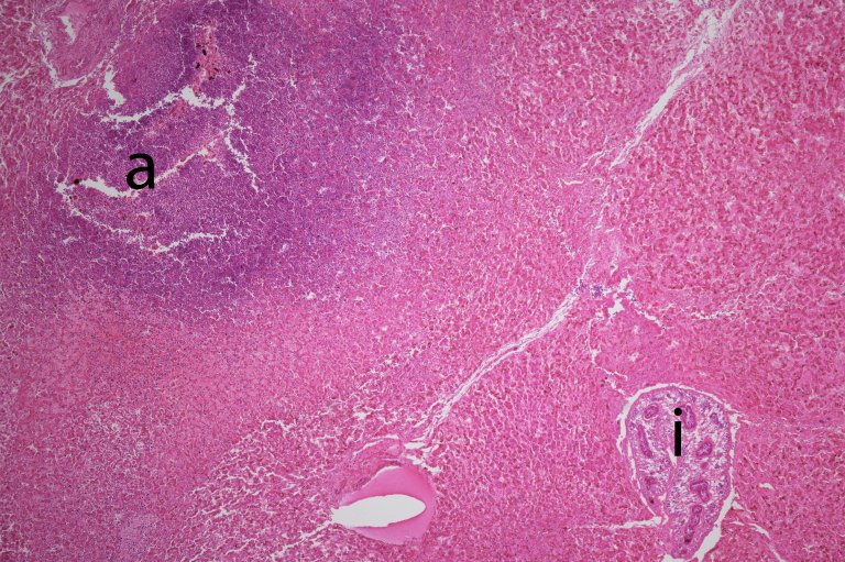 Figur 3. p512-17. Lever med absces og ikte_web.jpg